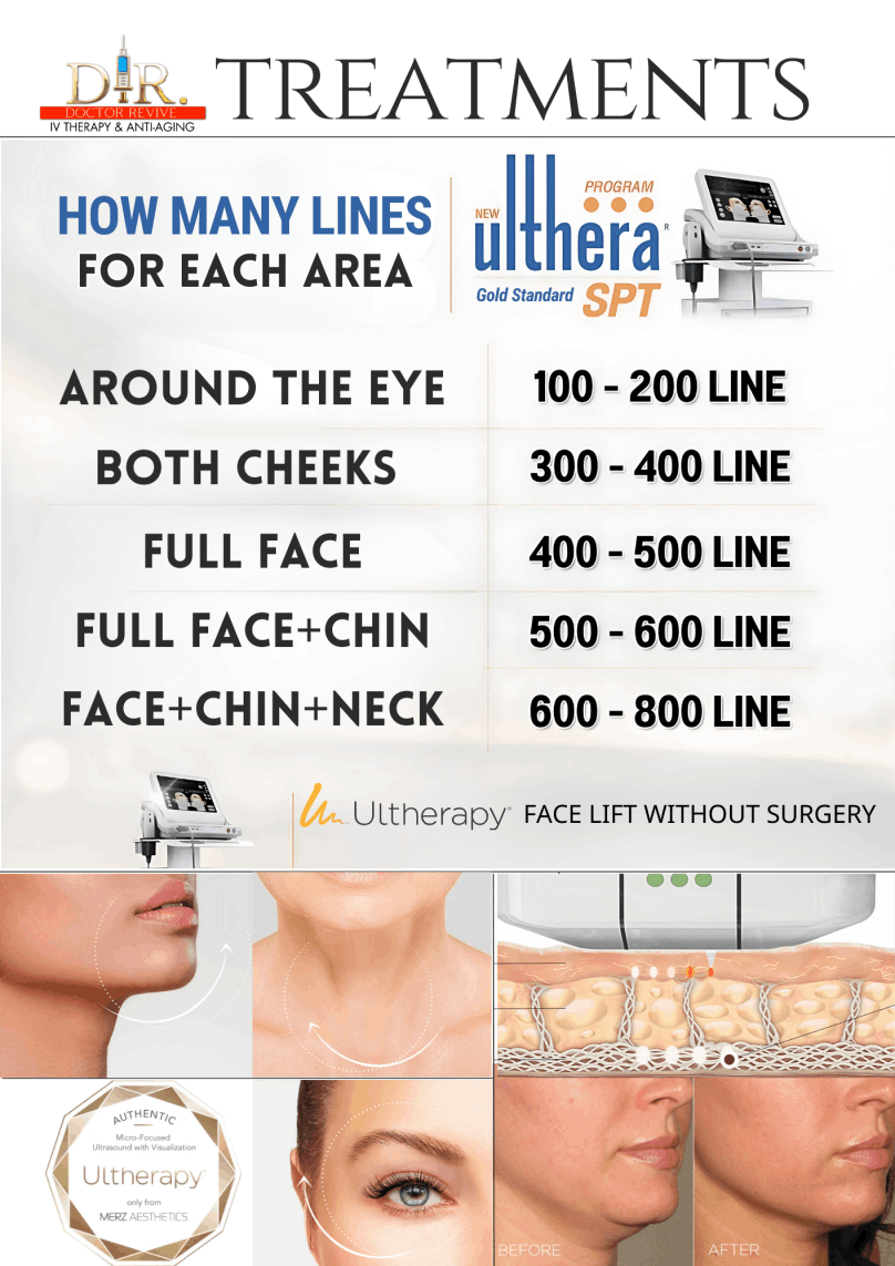 Ultherapy how many Lines